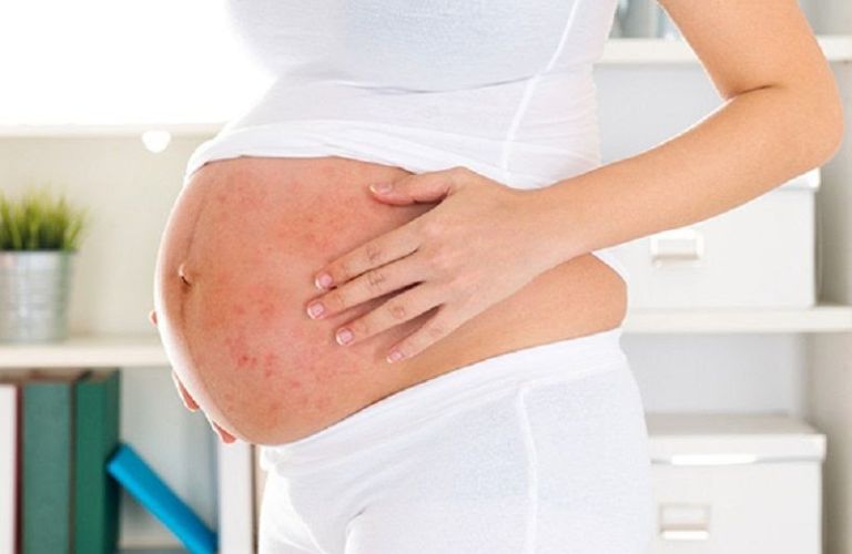 Tình trạng bà bầu bị nổi mẩn ngứa là gì?