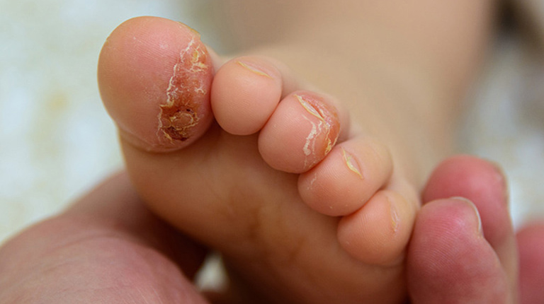 Bệnh á sừng ở trẻ sơ sinh