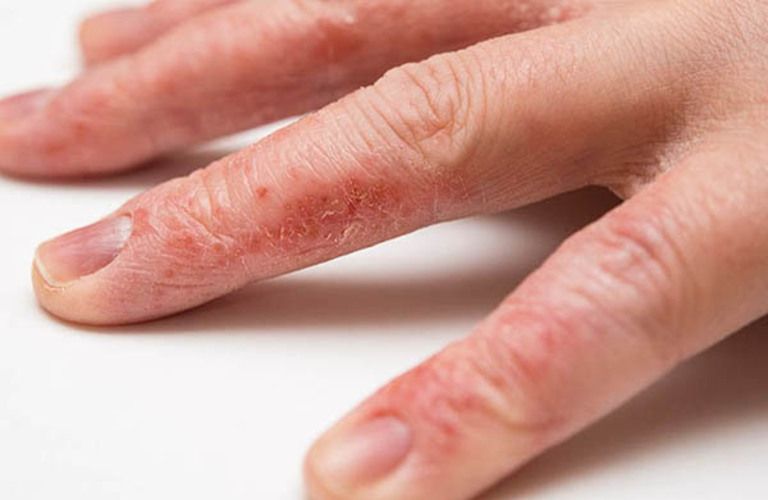 Bị chàm ở tay chân gây thay đổi hình thái da