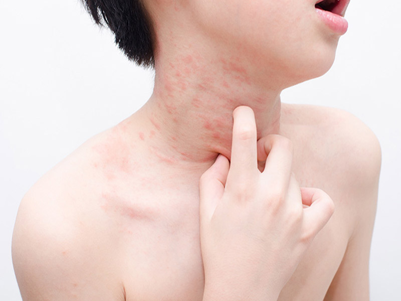 Nổi Mẩn Ngứa Ở Cổ