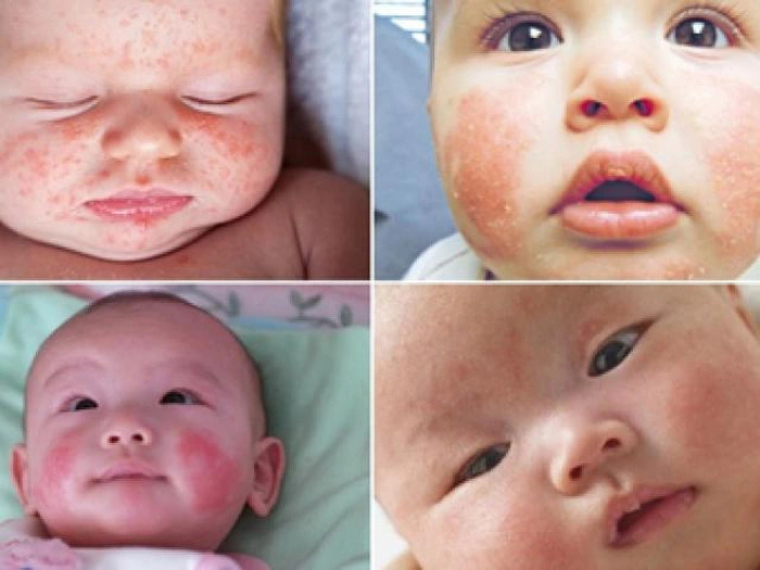 Chàm đồng tiền ở trẻ em là gì