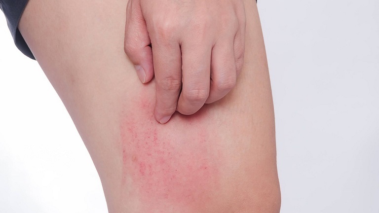 Nổi mẩn ngứa ở chân là gì?