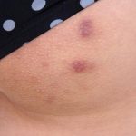 Vùng mông xuất hiện các nốt mẩn đỏ, sần sùi, kèm theo cảm giác ngứa ngáy khó chịu