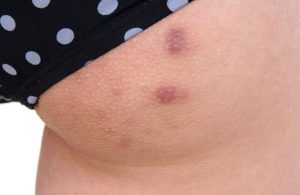 Vùng mông xuất hiện các nốt mẩn đỏ, sần sùi, kèm theo cảm giác ngứa ngáy khó chịu