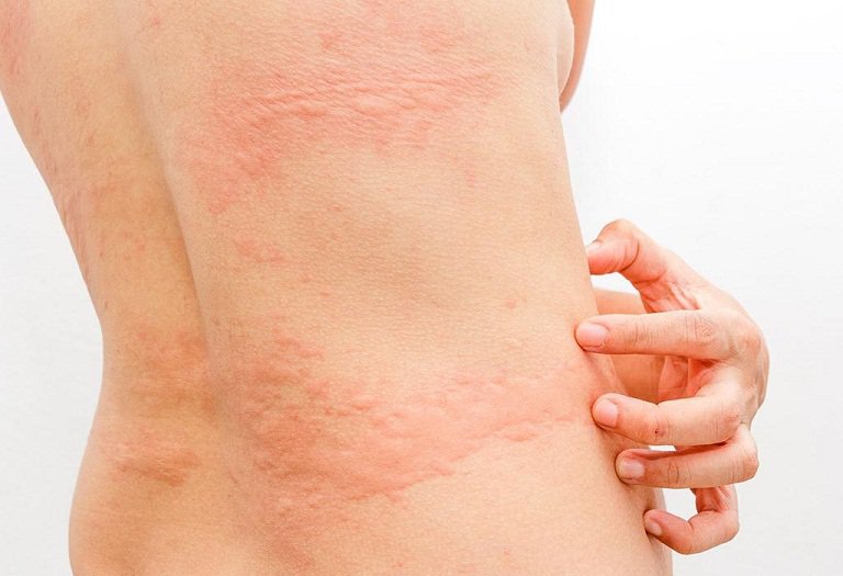 Nổi mề đay sau sinh là bệnh gì?