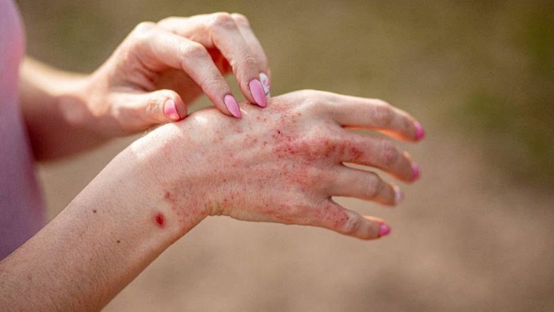 15 thuốc trị viêm da cơ địa hiệu quả nhanh chóng