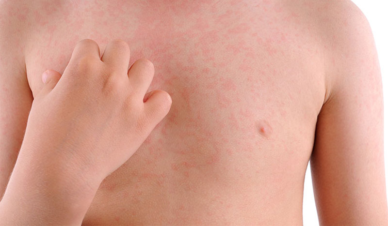 Hiện tượng trẻ bị nổi mề đay là gì? Có nguy hiểm không?