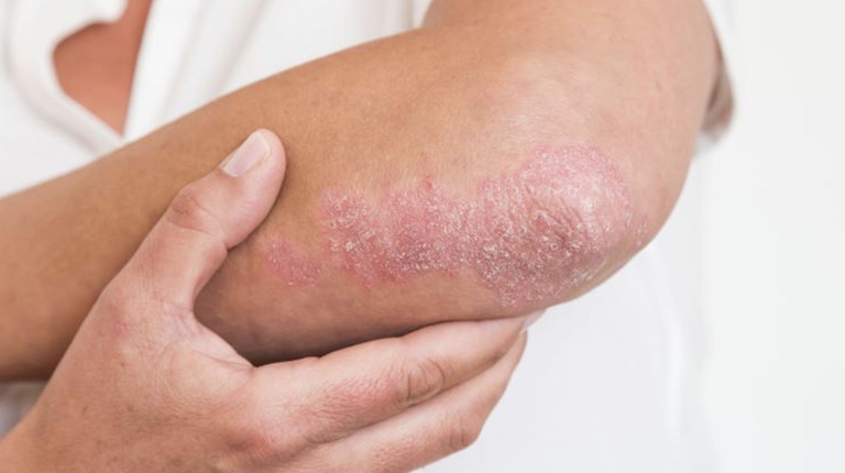 Vảy nến đồng tiền là bệnh gì? Có nguy hiểm không?