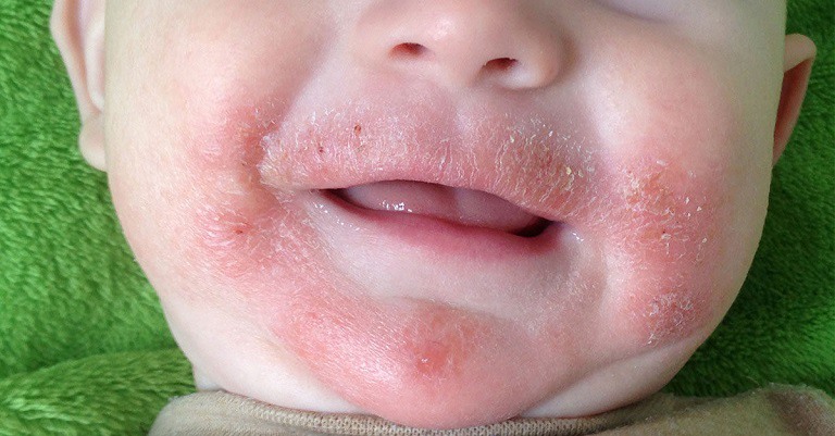 Viêm da cơ địa ở trẻ em là gì?