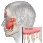 Viêm xoang hàm là tình trạng viêm nhiễm xảy ra tại các xoang nằm ở vùng má, gần mũi, thường xuất hiện sau khi bị cảm lạnh hoặc nhiễm trùng hô hấp