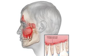 Viêm xoang hàm là tình trạng viêm nhiễm xảy ra tại các xoang nằm ở vùng má, gần mũi, thường xuất hiện sau khi bị cảm lạnh hoặc nhiễm trùng hô hấp