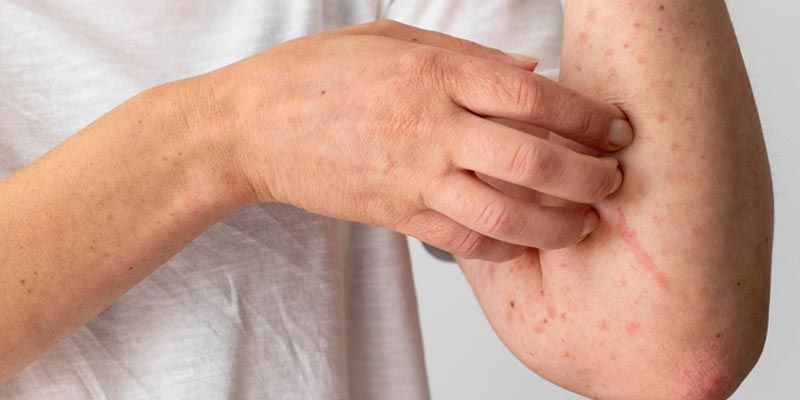 Viêm da cơ địa gây nên tình trạng ngứa ngáy, khô da, và xuất hiện các mảng đỏ trên da