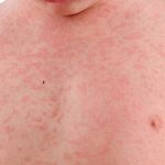 Mẩn đỏ có thể có màu hồng nhạt, đỏ tươi, đỏ sẫm hoặc tím tái