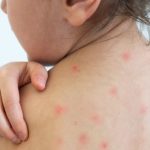 Trẻ bị tay chân miệng là nguyên nhân khiến bé nổi mẩn đỏ khắp người