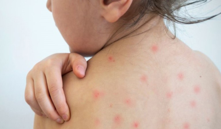 Trẻ bị tay chân miệng là nguyên nhân khiến bé nổi mẩn đỏ khắp người