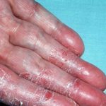Bệnh á sừng là một rối loạn di truyền phổ biến đặc trưng bởi tình trạng da khô, bong vảy giống như vảy cá