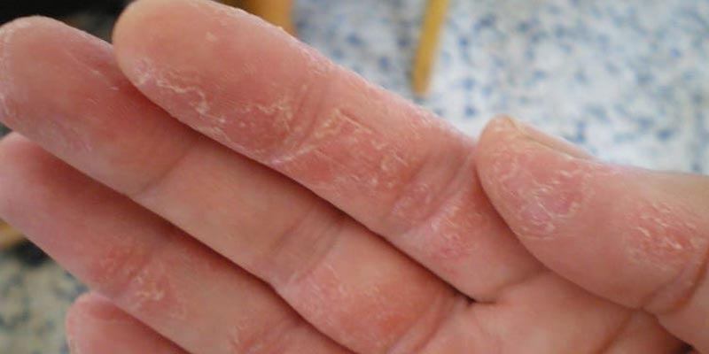 Bị bệnh á sừng bôi thuốc gì?