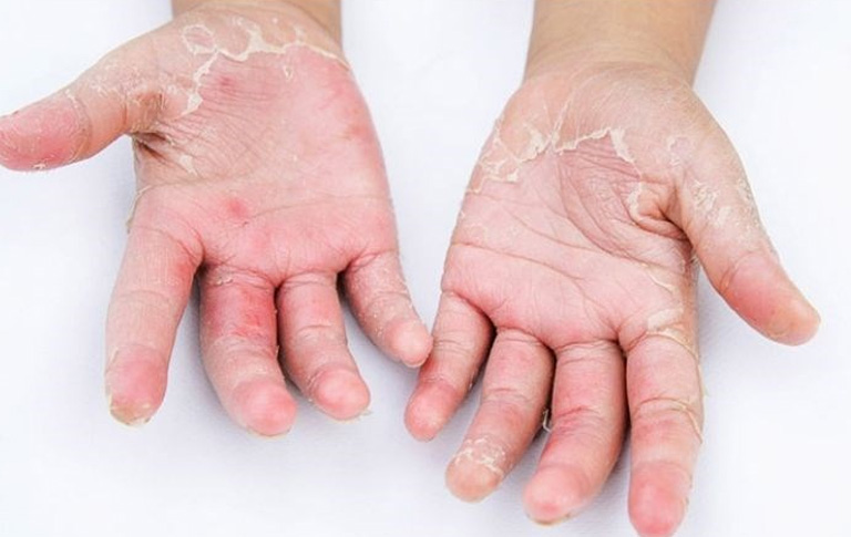 Á sừng có thể coi là một dạng viêm da cơ địa. Nghĩa là nó có liên quan nhiều yếu yếu tố tự miễn và đặc thù cơ địa của từng người.