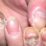 Bệnh á sừng có thể lan rộng nếu không được điều trị sớm