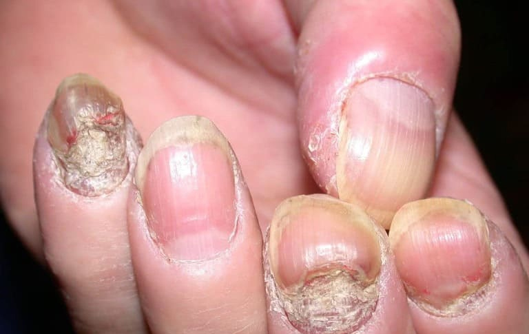 Bệnh á sừng có thể lan rộng nếu không được điều trị sớm