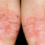 Bệnh chàm có chữa khỏi được không là vấn đề khiến nhiều người băn khoăn.