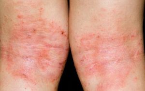 Bệnh chàm có chữa khỏi được không là vấn đề khiến nhiều người băn khoăn.