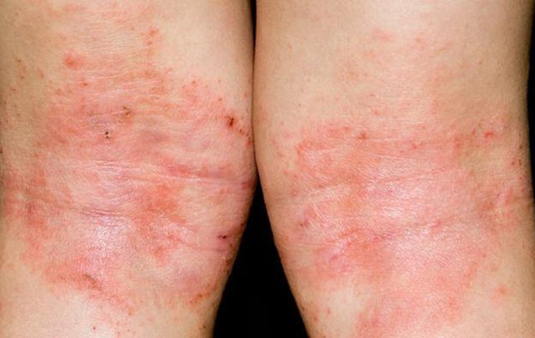 Bệnh chàm có chữa khỏi được không là vấn đề khiến nhiều người băn khoăn.