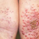 Chàm bội nhiễm xảy ra khi virus, nấm và vi khuẩn xâm nhập vào da và gây nhiễm trùng