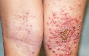 Chàm bội nhiễm xảy ra khi virus, nấm và vi khuẩn xâm nhập vào da và gây nhiễm trùng