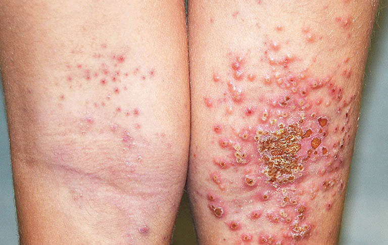 Chàm bội nhiễm xảy ra khi virus, nấm và vi khuẩn xâm nhập vào da và gây nhiễm trùng