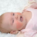 Nếu không có biện pháp chăm sóc và không giữ gìn vùng da bị chàm sữa sạch sẽ, người bệnh có thể bị nhiễm khuẩn da, nặng hơn có thể bị bội nhiễm và hình thành sẹo
