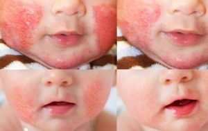 Chàm sữa CÓ KHẢ NĂNG TỰ KHỎI trong một số trường hợp