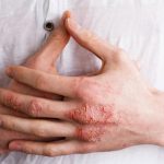 Bệnh eczema có chữa khỏi được không?