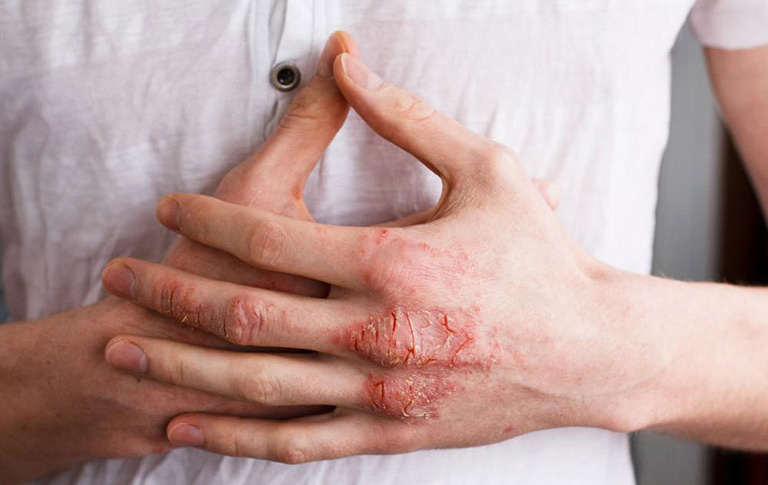 Bệnh eczema có chữa khỏi được không?