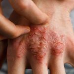 Chàm eczema là căn bệnh mạn tính dai dẳng. Vậy bệnh eczema có lây không?