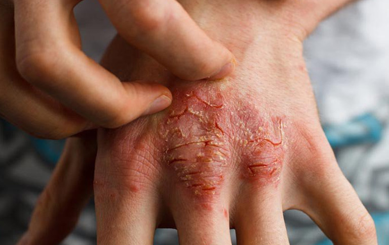 Chàm eczema là căn bệnh mạn tính dai dẳng. Vậy bệnh eczema có lây không?