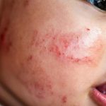 Bệnh Eczema xảy ra ở trẻ sơ sinh dễ chuyển biến phức tạp vì hệ miễn dịch của bé còn yếu.