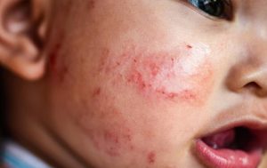 Bệnh Eczema xảy ra ở trẻ sơ sinh dễ chuyển biến phức tạp vì hệ miễn dịch của bé còn yếu.