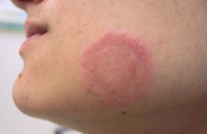 Tìm hiểu bệnh hắc lào có lây không? Lây bằng hình thức gì? Biện pháp phòng ngừa lây nhiễm hiệu quả