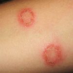 Tìm hiểu bệnh hắc lào có nguy hiểm không? Biện pháp phòng ngừa biến chứng