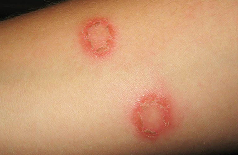 Tìm hiểu bệnh hắc lào có nguy hiểm không? Biện pháp phòng ngừa biến chứng