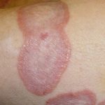 Hắc lào tạo thành những nốt hình tròn, ngứa trên da người bệnh