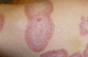 Hắc lào tạo thành những nốt hình tròn, ngứa trên da người bệnh