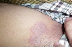Háng là vùng da nhạy cảm, ẩm ướt nên rất dễ mắc bệnh hắc lào