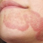 Bệnh hắc lào do các loại nấm thuộc nhóm dermatophytes gây ra