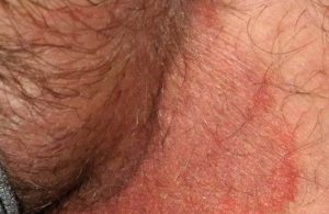 Tổn thương do bệnh hắc lào ở vùng kín nam giới