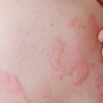 Bệnh nổi mề đay không lây nhưng dễ tái phát và có thể gây ra nhiều biến chứng nguy hiểm nếu không được kiểm soát tốt
