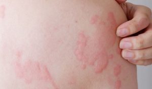 Bệnh nổi mề đay không lây nhưng dễ tái phát và có thể gây ra nhiều biến chứng nguy hiểm nếu không được kiểm soát tốt