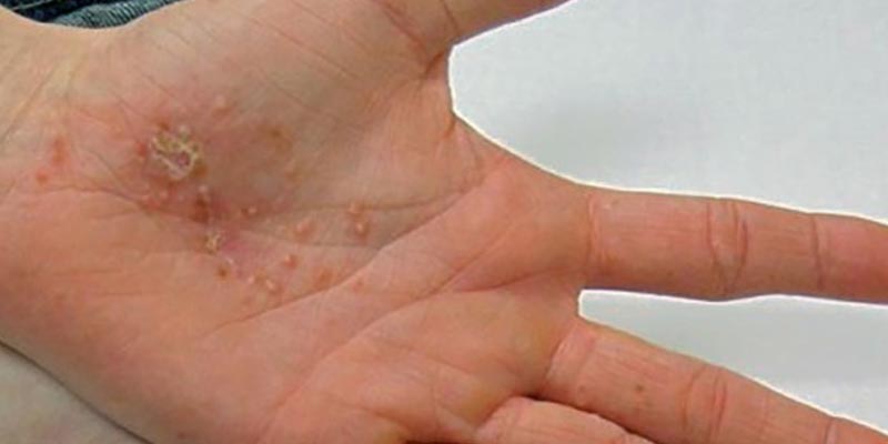 Nguyên nhân và yếu tố gia tăng nguy cơ mắc bệnh tổ đỉa