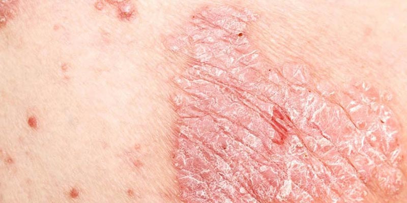 Bệnh vảy nến có tự khỏi không?